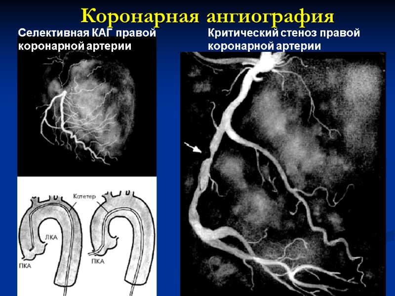 28 Селективная КАГ правой  коронарной артерии  Критический стеноз правой  коронарной артерии